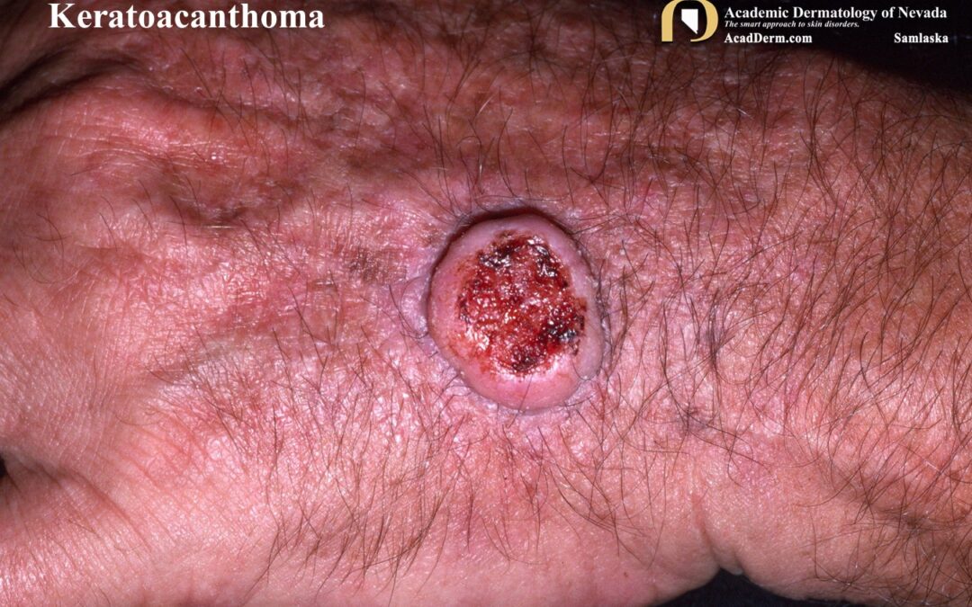 Keratoacanthoma:  Low Grade Squamous Cell Carcinomas…