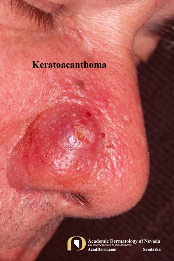 KA5Samlaska - Academic Dermatology of Nevada