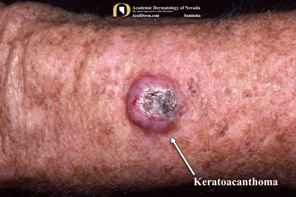 KA6Samlaska - Academic Dermatology of Nevada