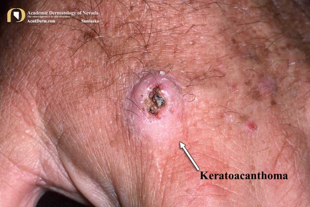 KA7Samlaska - Academic Dermatology of Nevada