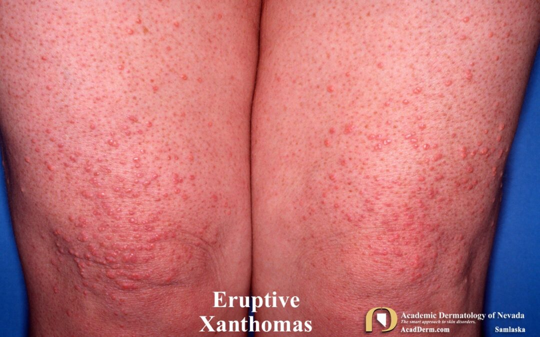 Xanthomas:  Signs of Dyslipidemia…