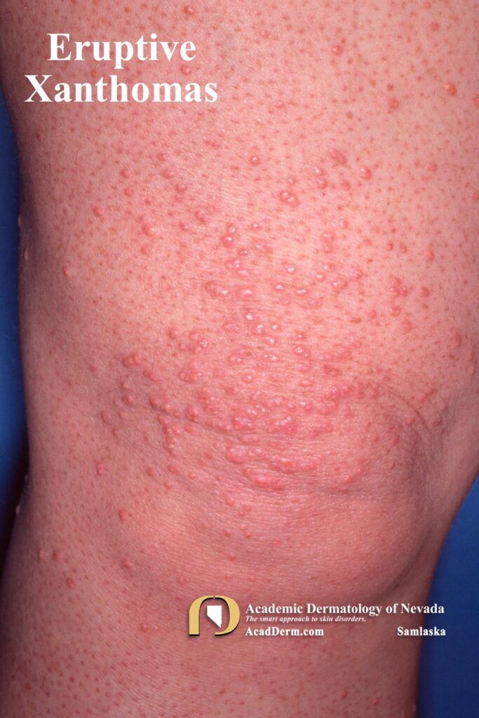 EruptXanthomas2Samlaska - Academic Dermatology of Nevada