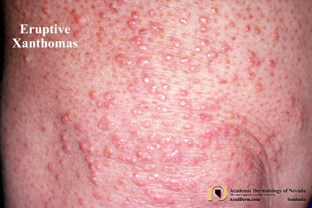 EruptXanthomas3Samlaska - Academic Dermatology of Nevada