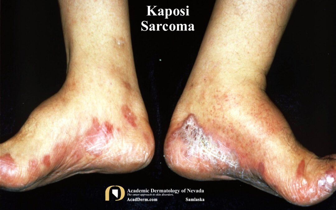 Kaposi Sarcoma:  The Old & The New…