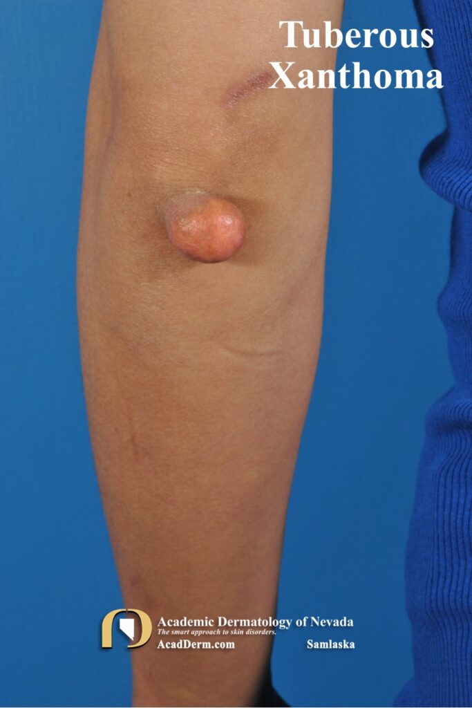 TubXanthoma1Samlaska - Academic Dermatology of Nevada