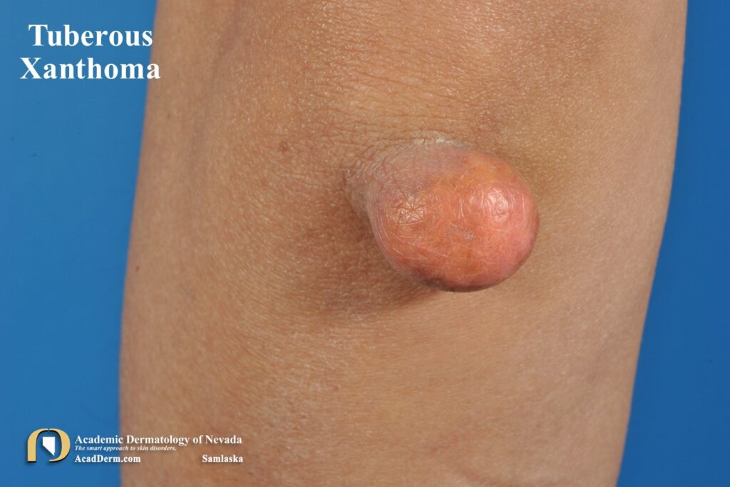 TubXanthomas2Samlaska - Academic Dermatology of Nevada