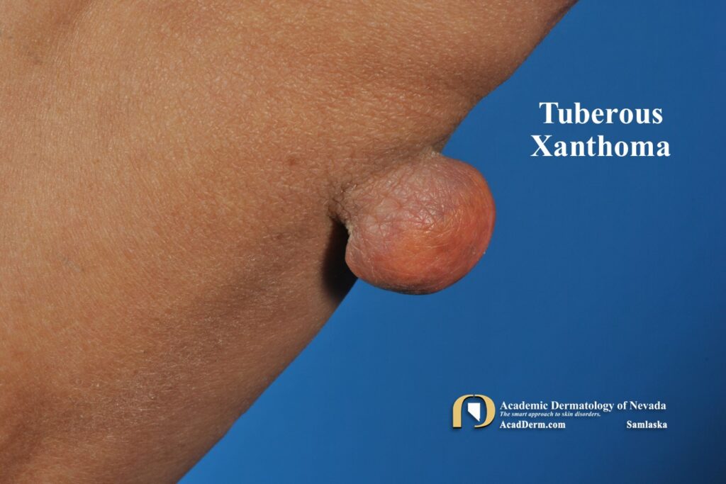 TubXanthomas3Samlaska - Academic Dermatology of Nevada