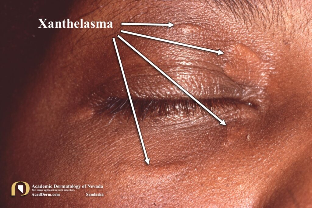 Xanthelasma1Samlaska - Academic Dermatology of Nevada