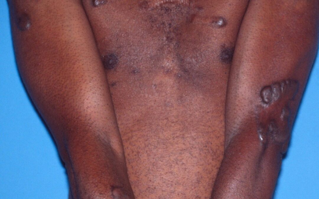 Keloids:  Beyond the Margins…