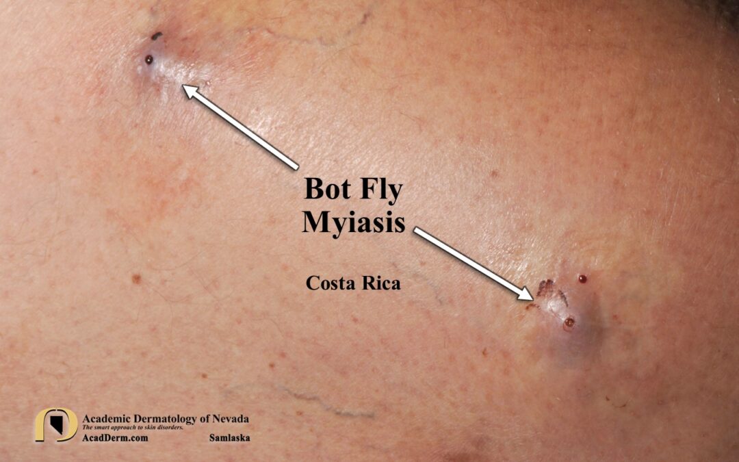 Bot Fly Myiasis:  What’s eating me…