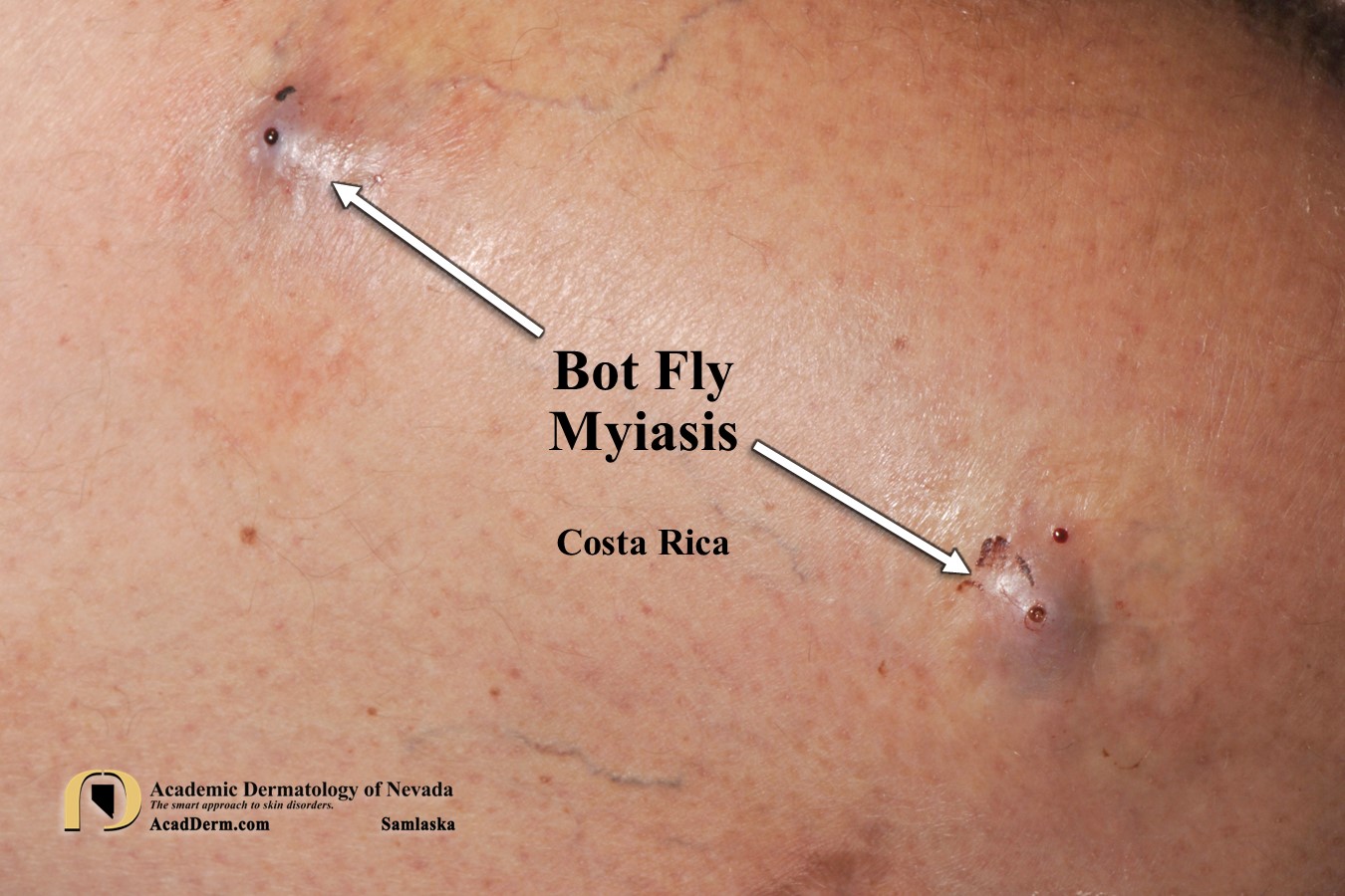 Flies Embedded In Skin