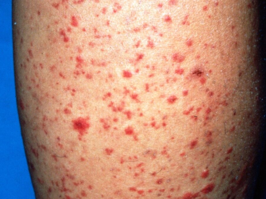 Leukocytoclastic Vasculitis:  Small-Vessel Vasculitis…