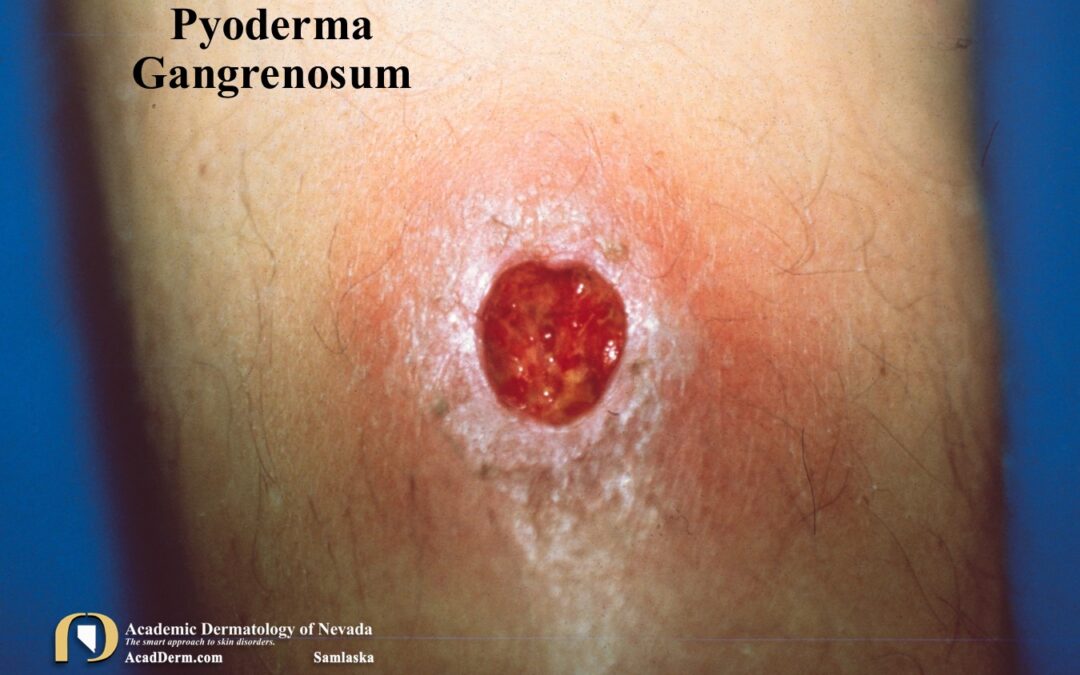 Pyoderma Gangrenosum:  It’s not an infection…