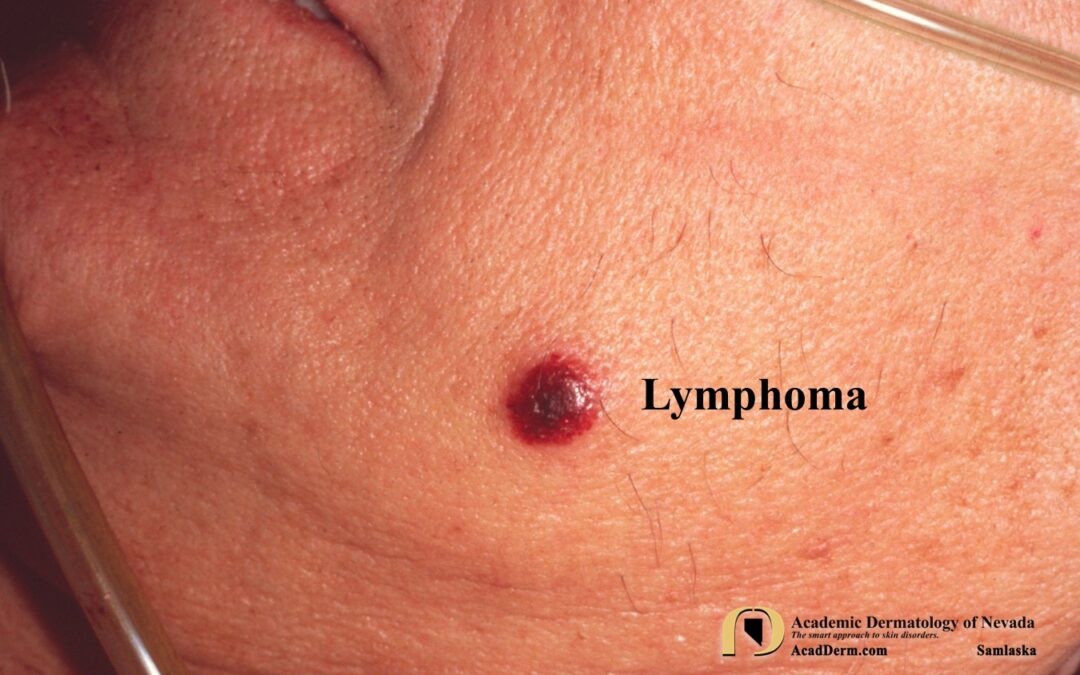 Cutaneous Lymphoma:  Please Contribute To The Leukemia & Lymphoma Society…