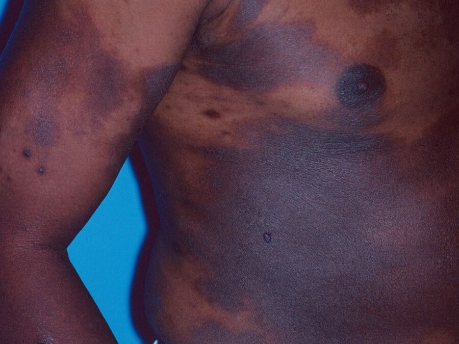 Mycosis Fungoides:  Cutaneous T-cell Lymphoma…