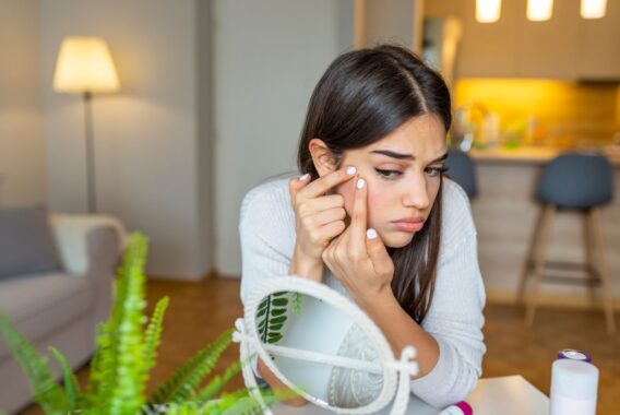 Best Winter Skin Care for Acne Prone Dry Skin
