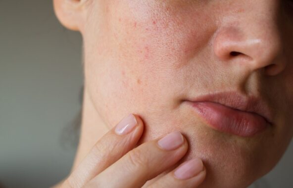 How to Keep My Skin Clear and Moisturized