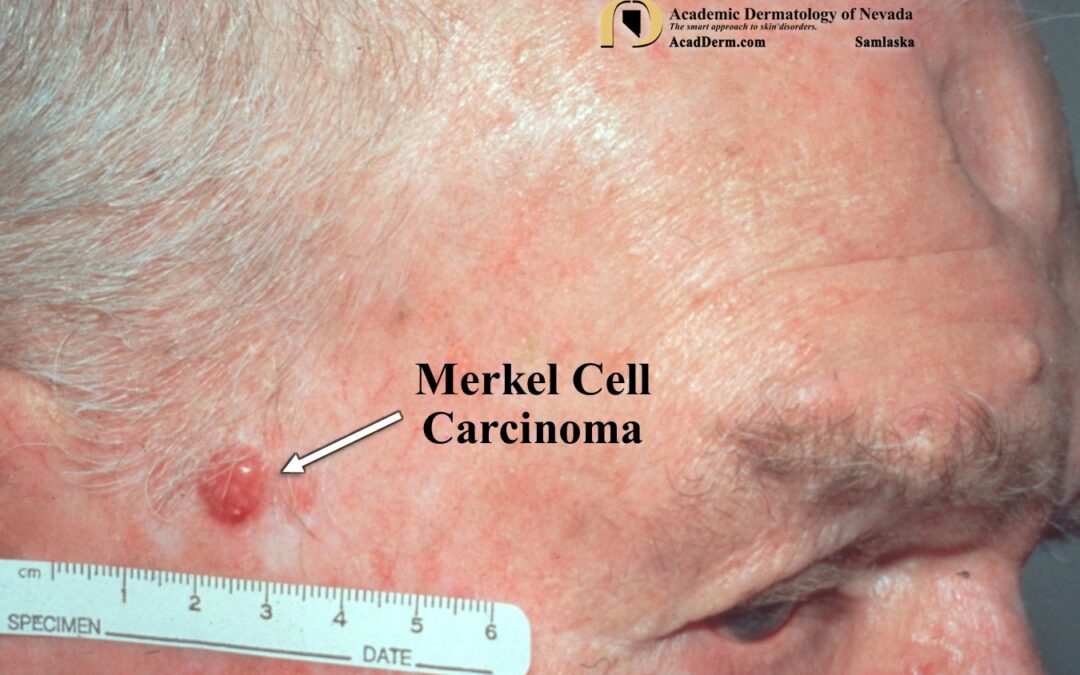 Merkel Cell Carcinoma:  Murky Cell Carcinoma…