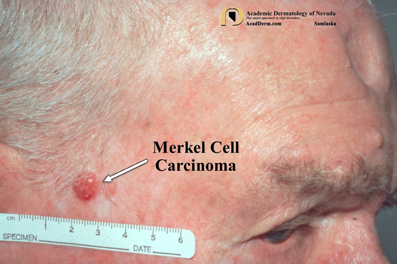 Merkel Cell Carcinoma:  Murky Cell Carcinoma…