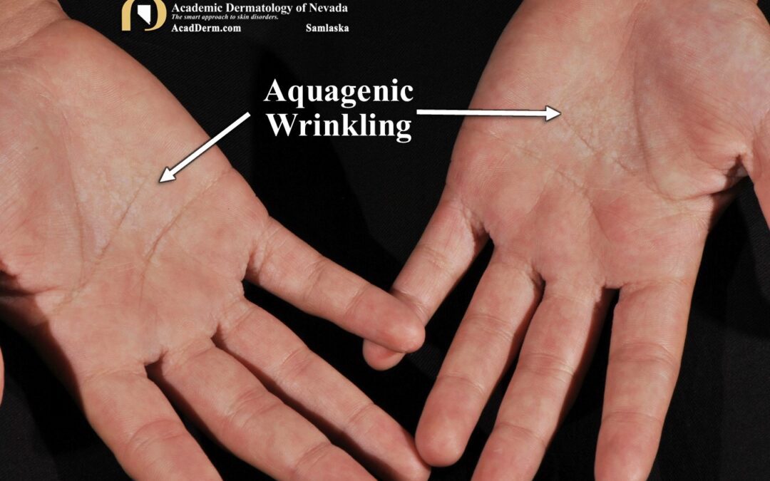 Aquagenic Wrinkling:  It burns…