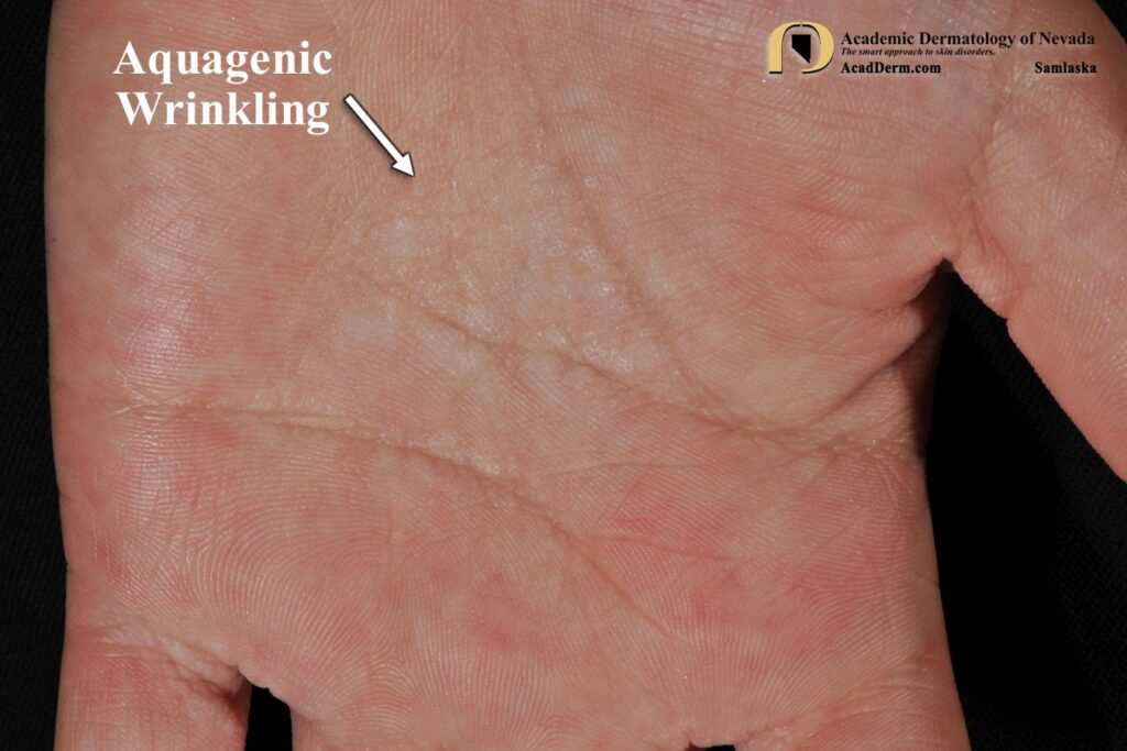 AquagenicWrinklingSamlaska2 - Academic Dermatology of Nevada
