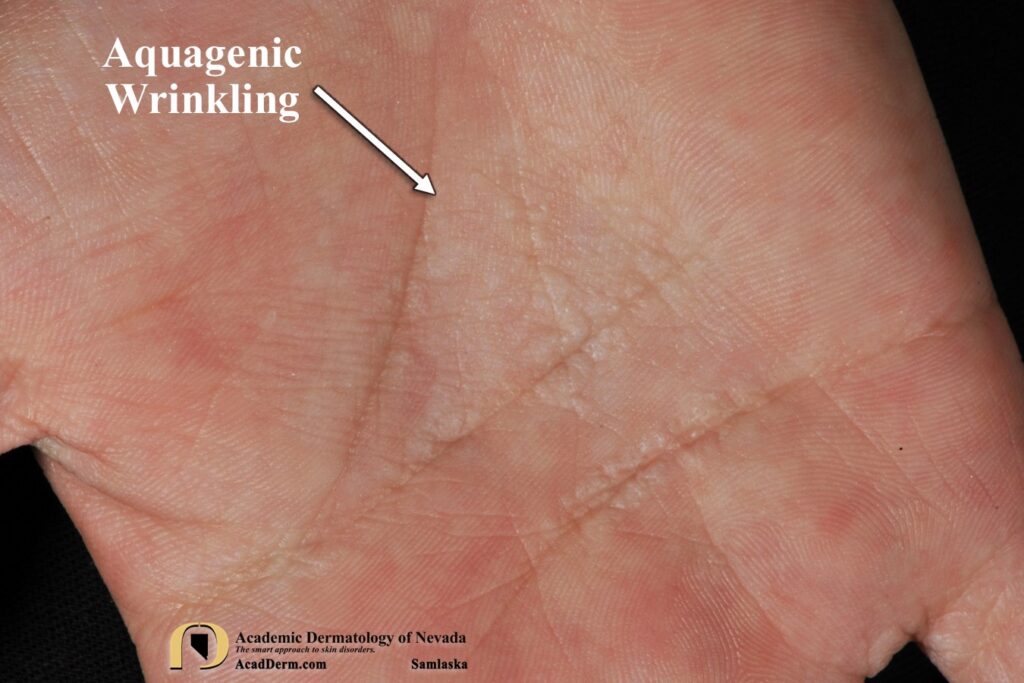 AquagenicWrinklingSamlaska3 - Academic Dermatology of Nevada