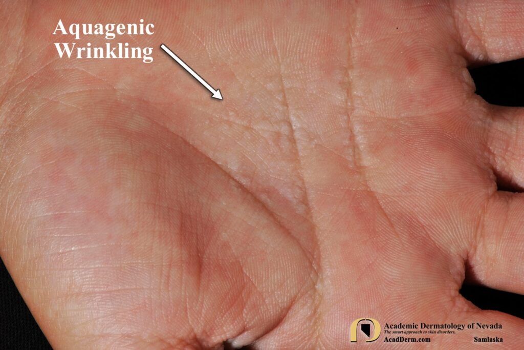 AquagenicWrinklingSamlaska4 - Academic Dermatology of Nevada