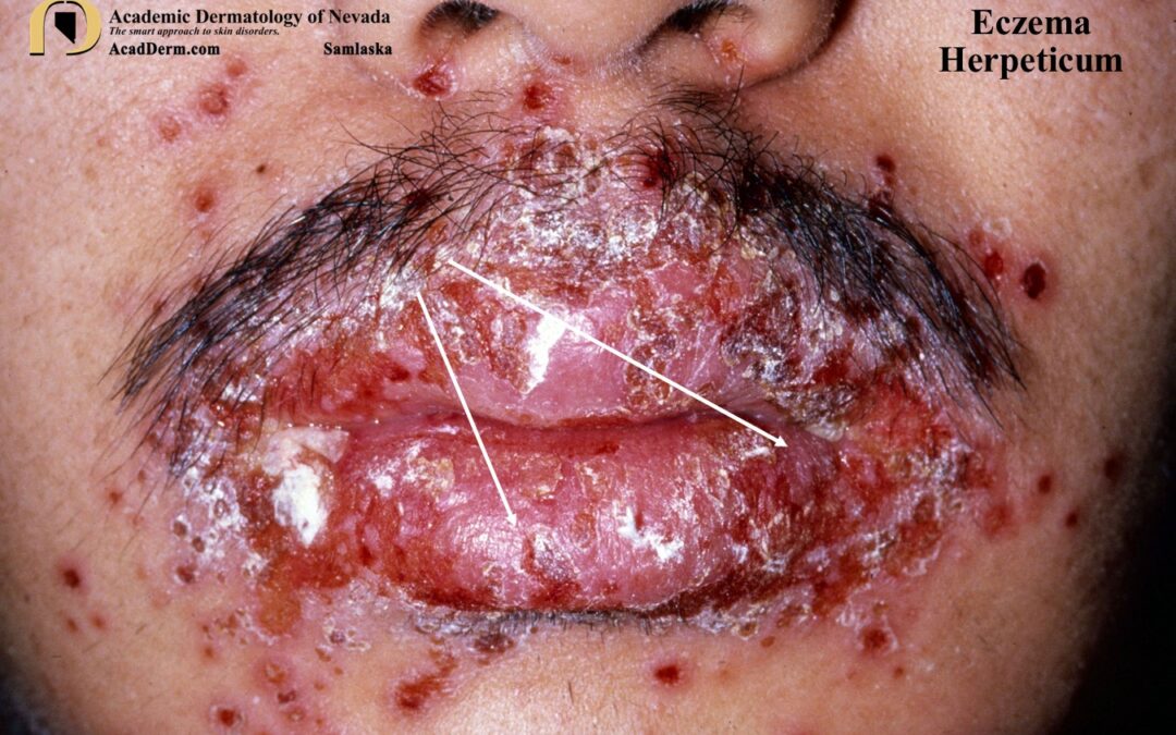Eczema Herpeticum:  Kaposi Varicelliform Eruption…