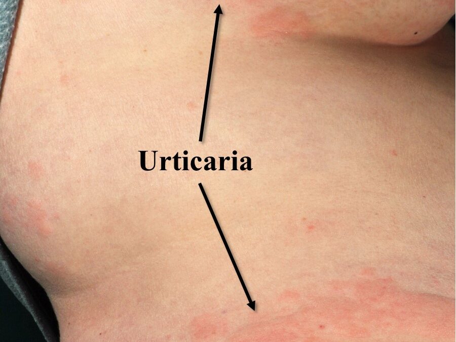 Urticaria:  Acute and Chronic Hives…