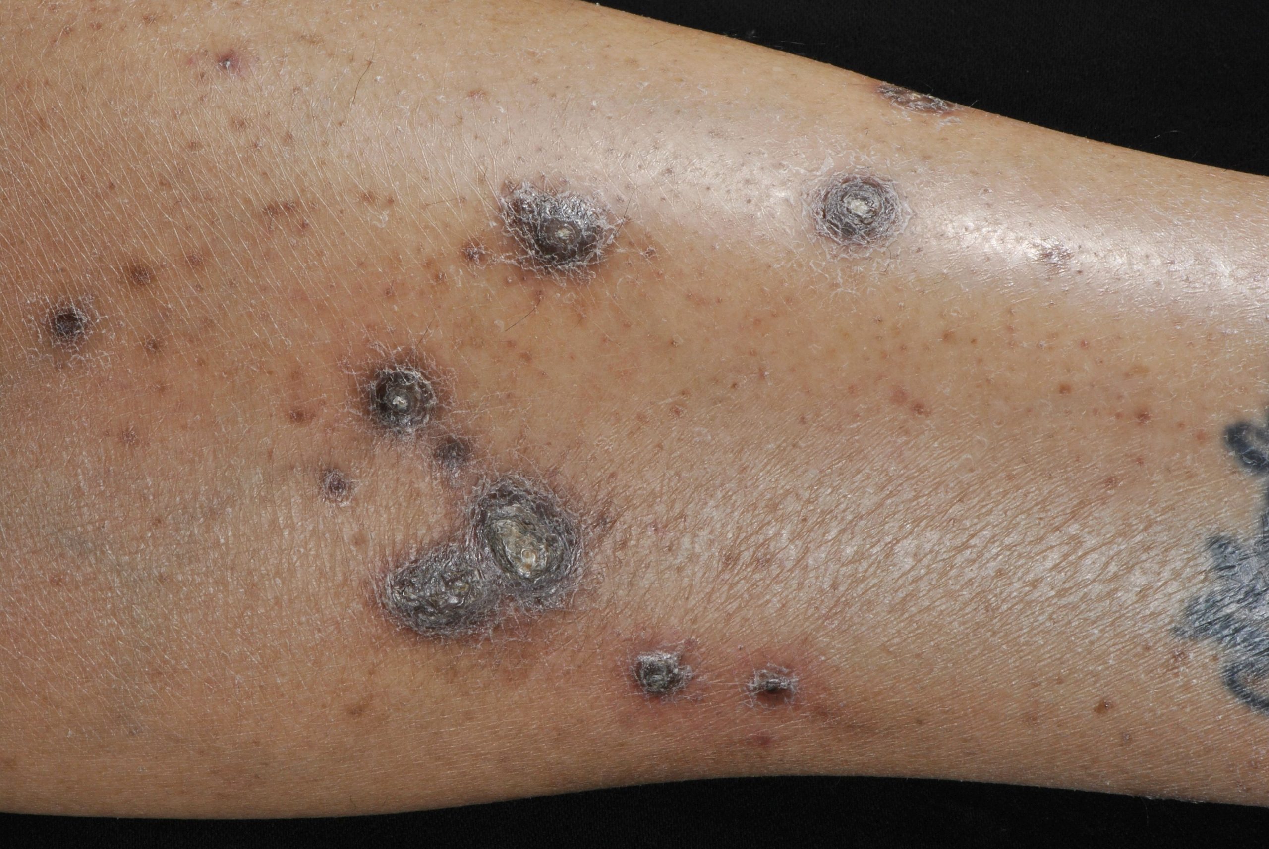 Unknown:  Itchy bumps on legs…