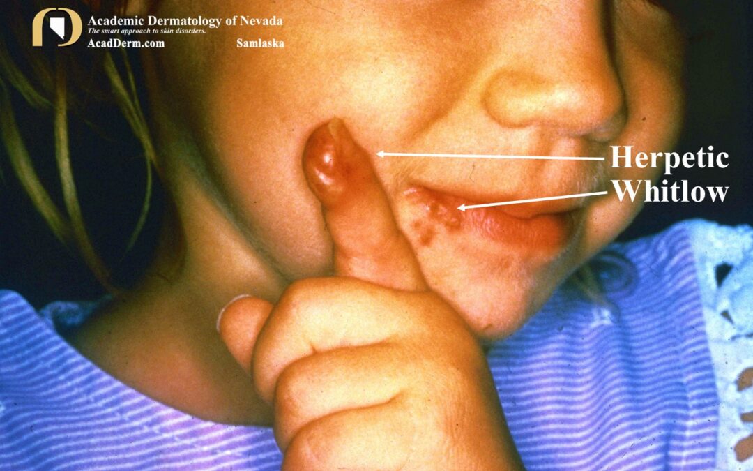 Herpetic Whitlow:  Herpes Manuum…